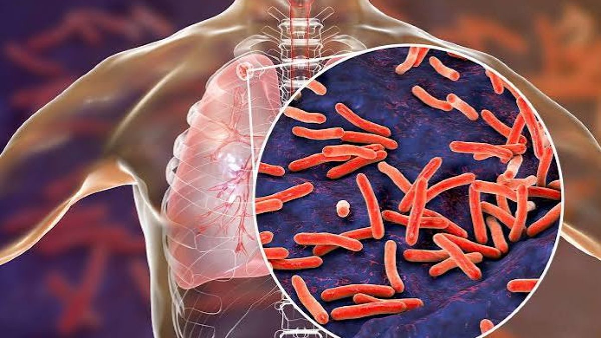 سل (توبرکلوز)؛ راهنمای کامل بیماران و خانواده‌ها